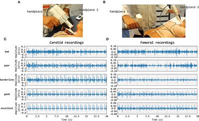 Template Matching and Matrix Profile for Signal Quality Assessment of Carotid and Femoral Laser Doppler Vibrometer Signals